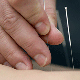 บทความสาระน่ารู้:-การฝังเข็ม (Acupuncture) คืออะไร? การเตรีมตัวก่อนการรักษา