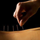 บทความสาระน่ารู้:-ฝังเข็ม (Acupuncture) ผิวสวย หน้าใส หน้าเด้ง อย่างยั่งยืน